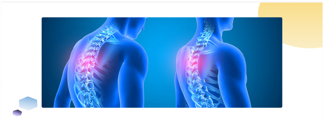 علاج انحناء العمود الفقري المتوسط