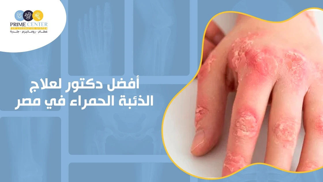 أفضل دكتور لعلاج الذئبة الحمراء في مصر