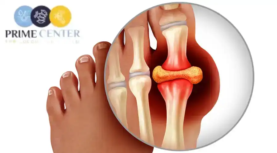 أفضل طرق علاج مرض النقرس