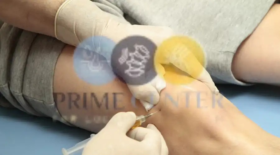 طريقة تنفيذ حقن البلازما للركبة