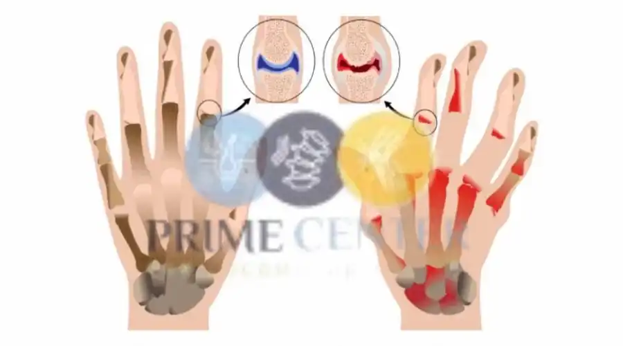 علاج الفيبروميالجيا