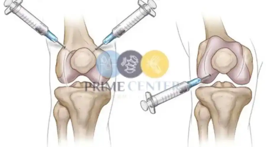فوائد حقن البلازما للركبة