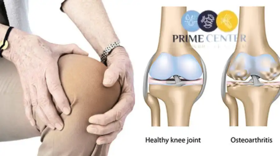 اسباب خشونة الركبة