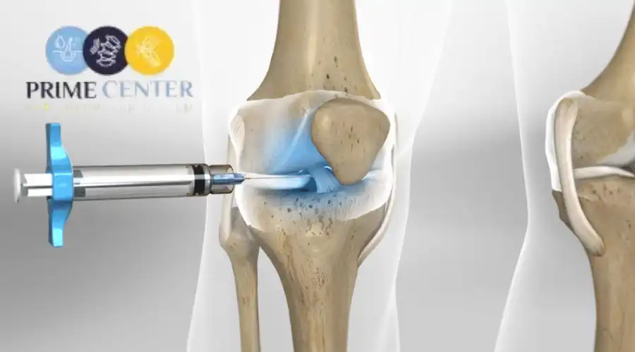 نصائح بعد حقن البلازما للركبة