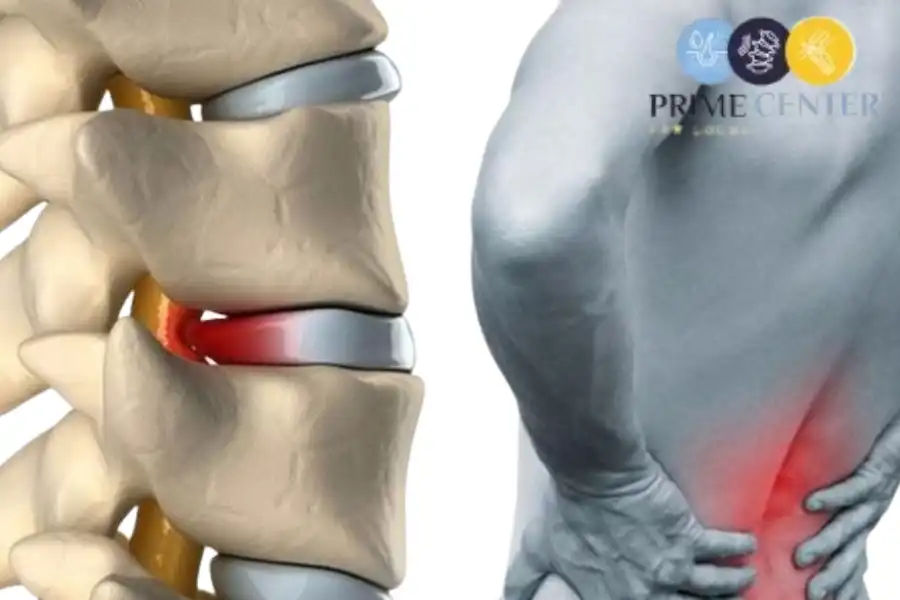 اعراض تشنج عضلات الظهر السفلية