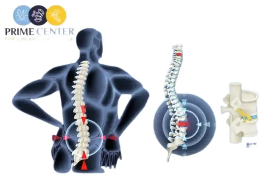 اعراض التهاب أعصاب الرقبة