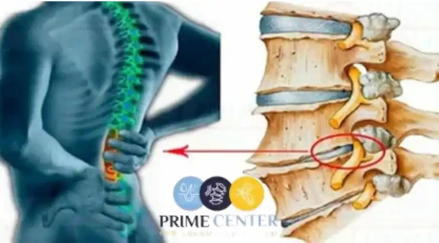 افضل مركز لعلاج تزحزح الفقرات العنقية والقطنية بدون جراحة