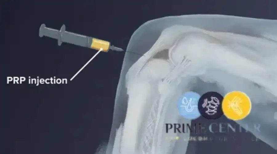 كيفية إجراء حقن البلازما في العظام