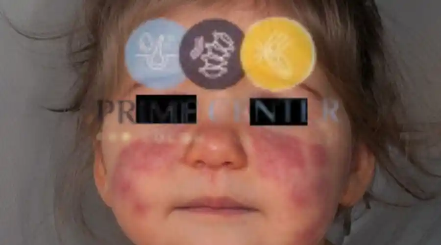 أسباب الذئبة عند الأطفال