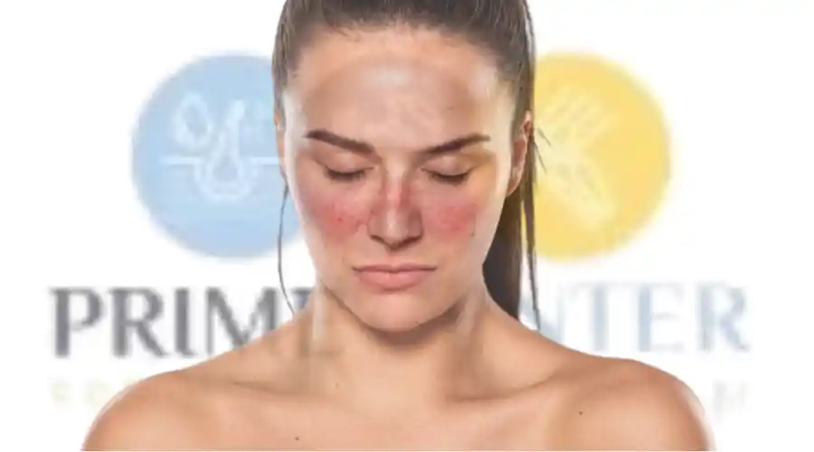 اعراض نشاط الذئبة الحمراء