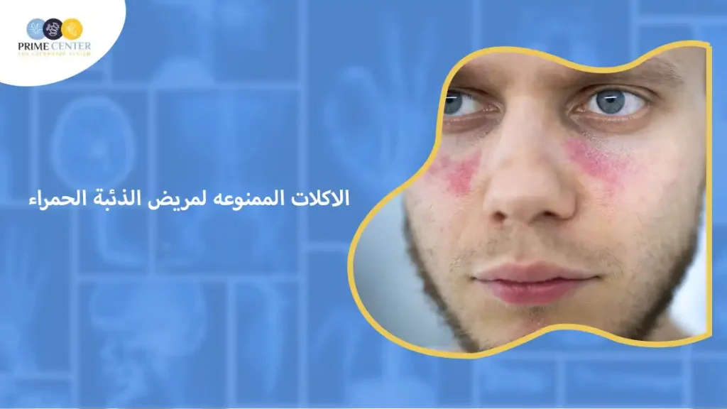 الاكلات الممنوعه لمريض الذئبة الحمراء