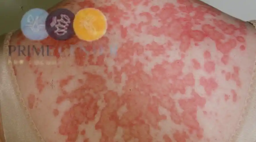 الذئبة الجلدية