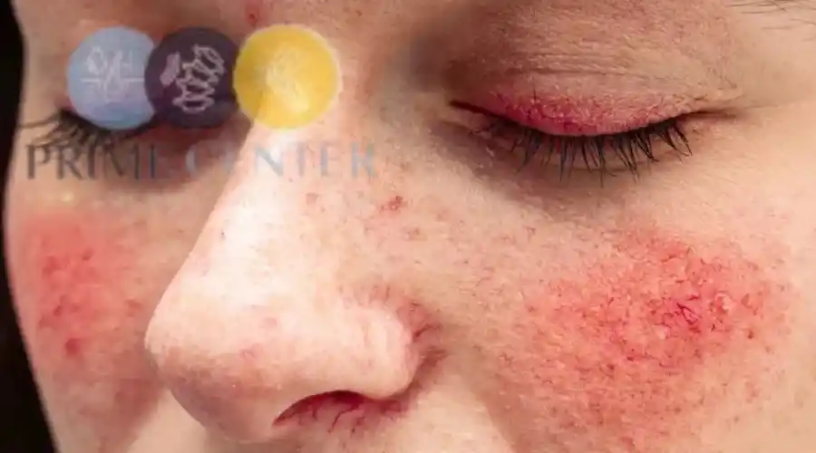 الذئبة الحمراء الجهازية