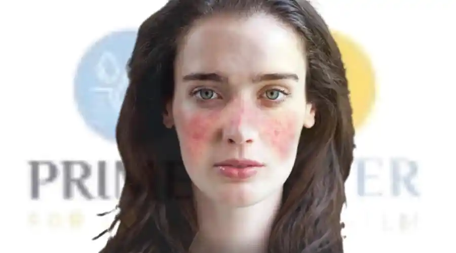 الفئات الأكثر عرضة للإصابة بمرض الذئبة الحمراء