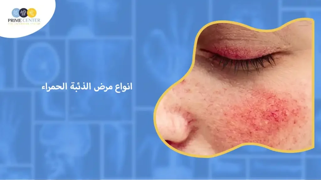 انواع مرض الذئبة الحمراء