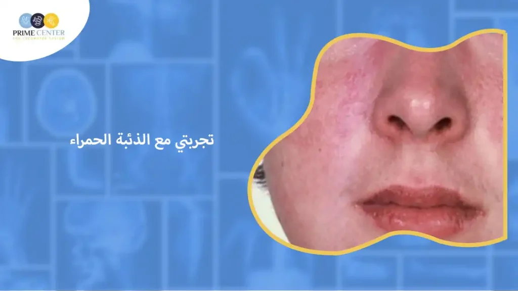 تجربتي مع الذئبة الحمراء
