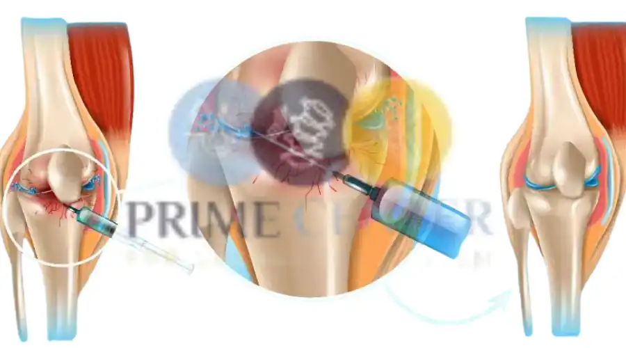 خطوات إجراء تقنية الحقن بالبلازما في الركبة