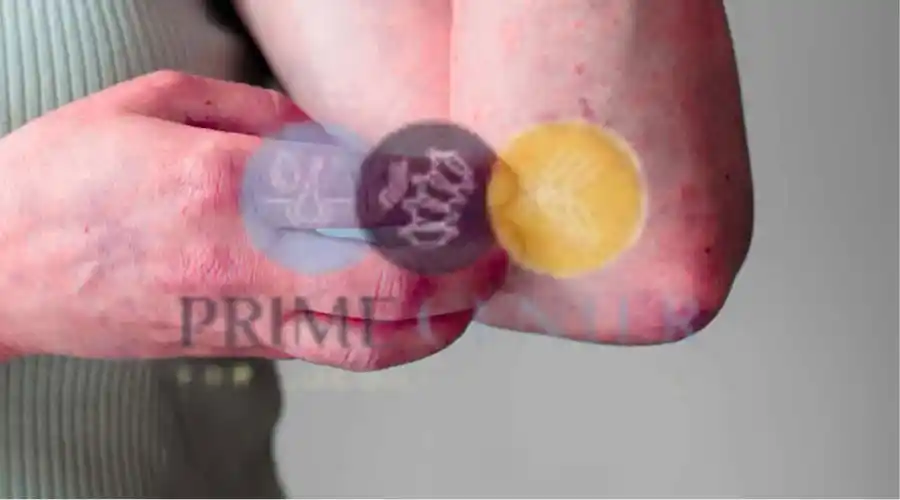 طرق علاج الذئبة الحمراء