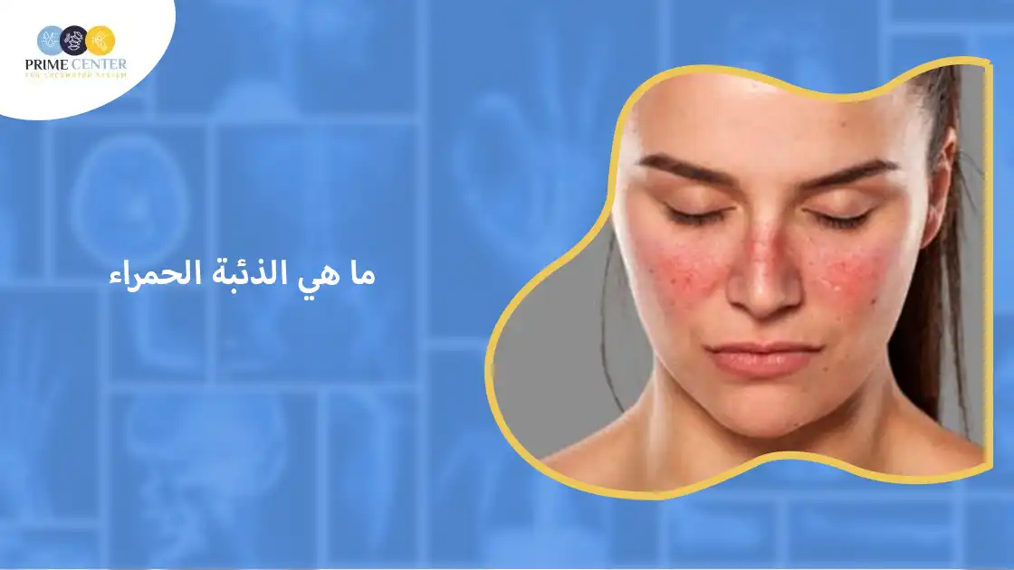 ما هي الذئبة الحمراء