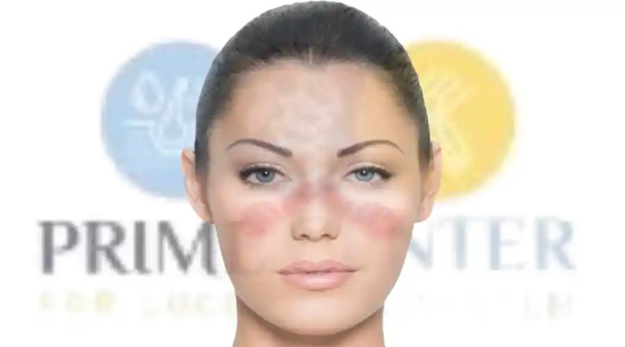 مضاعفات مرض الذئبة الحمراء