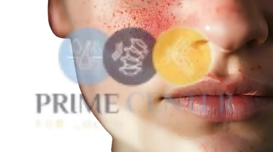 نصائح للتعامل مع الذئبة الحمراء