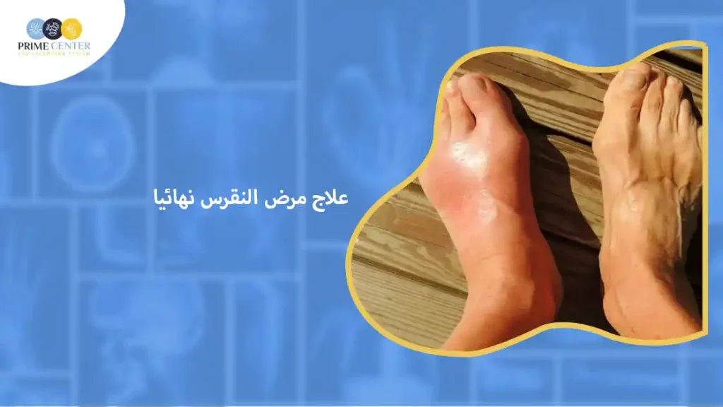 علاج مرض النقرس نهائيا