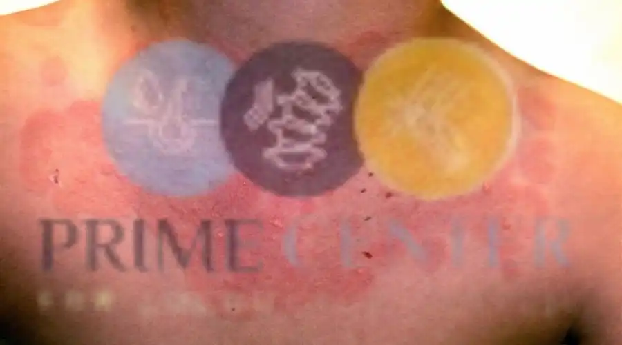 عوامل الخطورة مرض الذئبة الحمراء