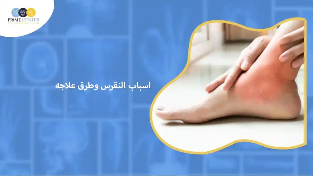 اسباب النقرس وطرق علاجه