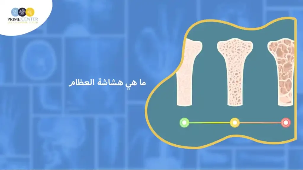 ما هي هشاشة العظام