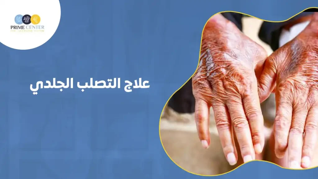 علاج التصلب الجلدي