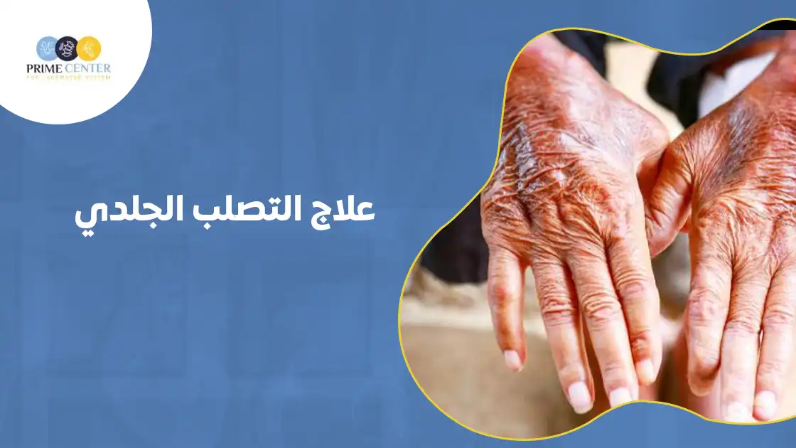 علاج التصلب الجلدي