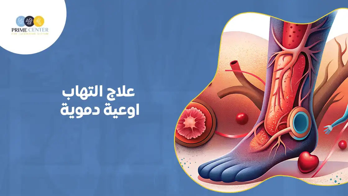 علاج التهاب اوعية دموية