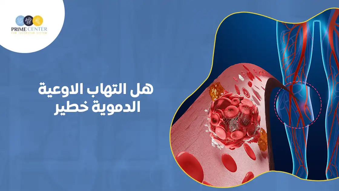 هل التهاب الاوعية الدموية خطير