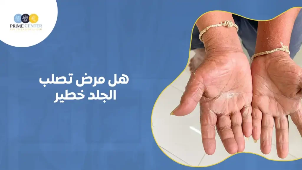 هل مرض تصلب الجلد خطير