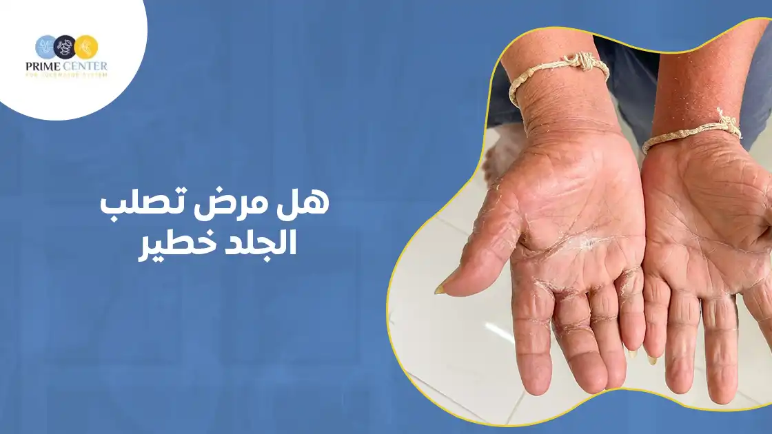 هل مرض تصلب الجلد خطير